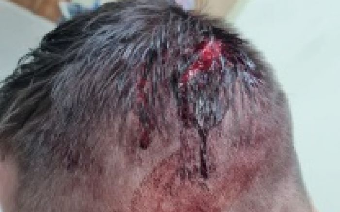 João levou pontos na cabeça e ficou com ferimentos nas costas e braços
(Foto: Divulgação)