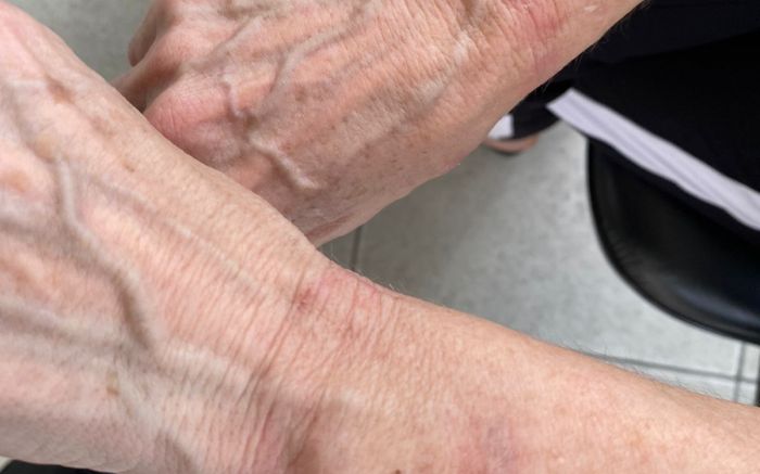Senhora ficou com as marcas nos pulsos