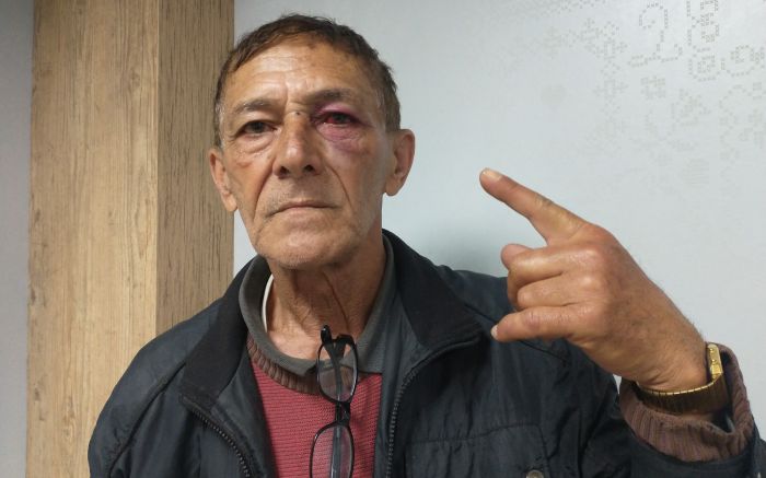 Seu Celso ficou com o olho machucado
(foto: Franciele Marcon)