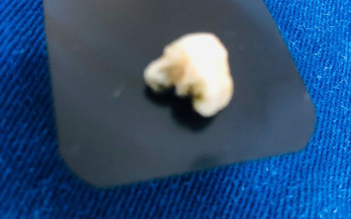 Dente foi encontrado dentro de marmita (Foto: leitor)