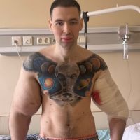Influenciador tira bíceps após injetar óleo para ficar com braços grandes