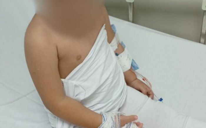 A pequena sofreu queimaduras na mão e corre risco de precisar de cirurgia (Foto: Leitor)